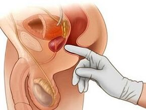 Prostatamassage zur Behandlung von Prostatitis bei Männern