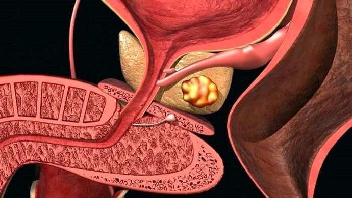 Steinablagerungen in der Prostata bei kalkhaltiger Prostatitis