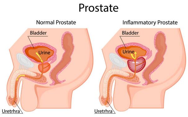 gesunde und entzündete Prostata