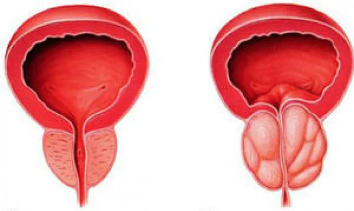 Normale Prostata (links) und chronisch entzündete Prostatitis (rechts)